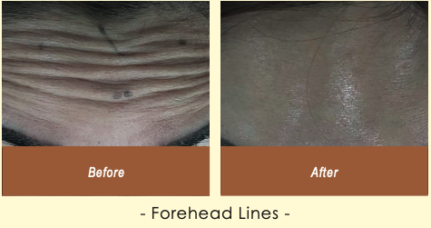 Before and after Forehead Lines