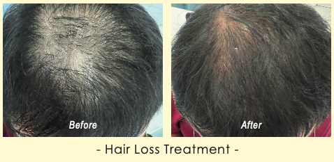 Before and after Hair Loss Treatment