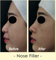 Before and after Nose Filler